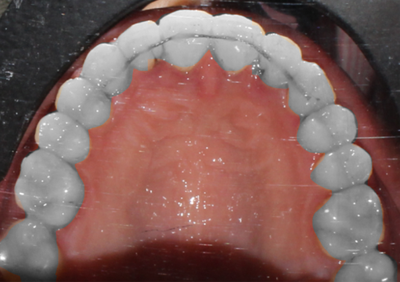 Bonding permanent retainers