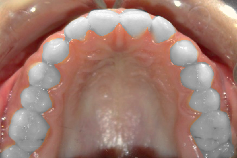 Closing  spaces between the teeth B