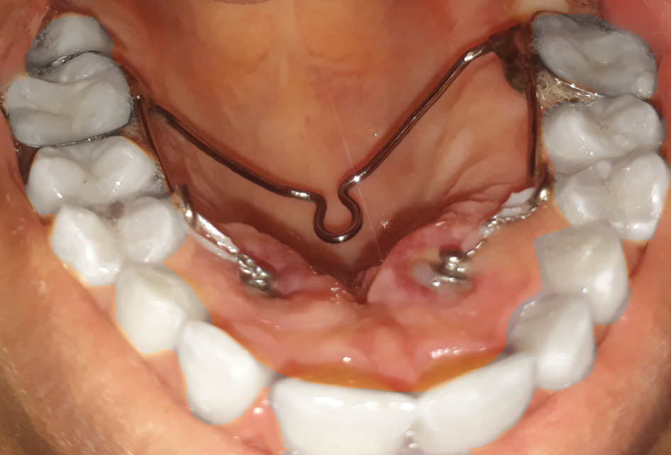 Orthodontic traction of impacted teeth and aligning them