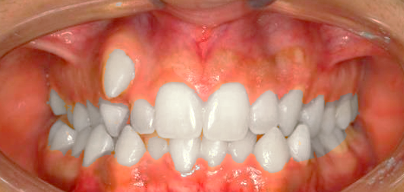 Alignment of ectopic eruption teeth B