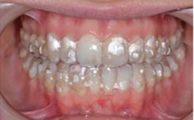 Orthodontic Aligners