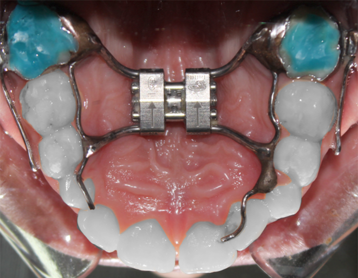 Adjustment of jaw growth devices