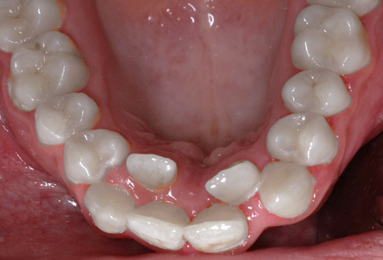 Alignment of Displaced teeth B