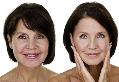 تقنية فراكشنال مايكرو نيدل من لشد ورفع البشرة بدون جراحة في مركز الحياة الطبي في قطر