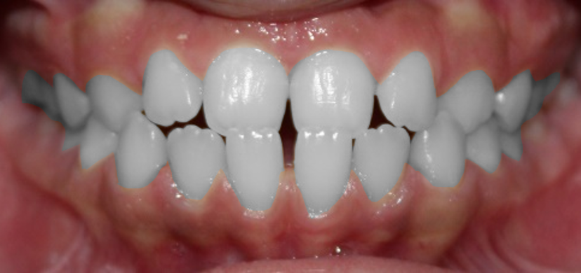 Correcting Crossbite B