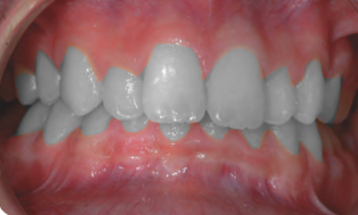 Treatment of Deep bite cases B