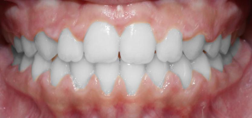 Correcting Crossbite A