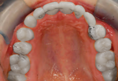 Treatment of missing teeth A