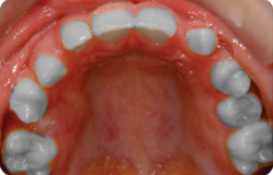 Treatment of missing teeth B1