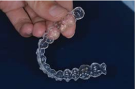 Orthodontic Aligners