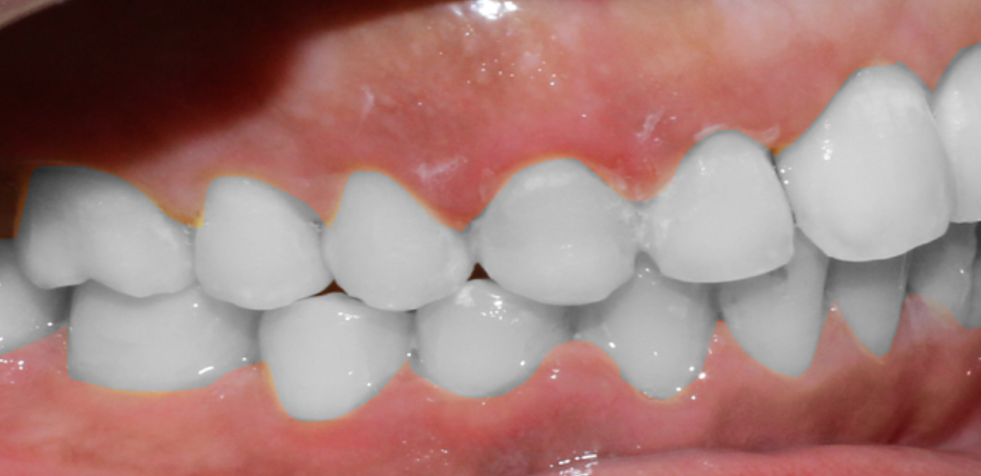 Treatment of arch protrusion A