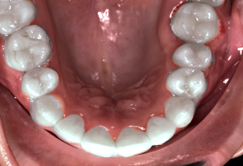 Alignment of Displaced teeth A