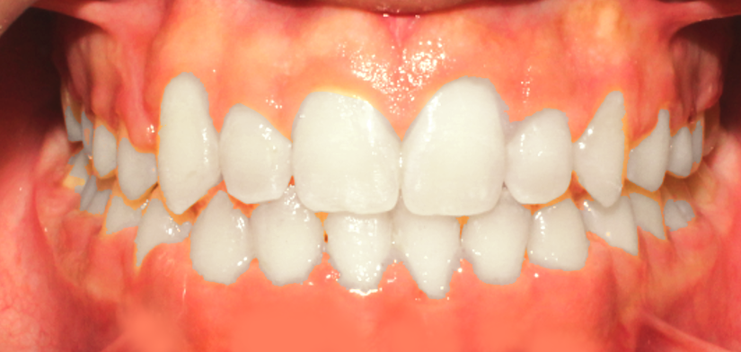 Alignment of ectopic eruption teeth A