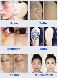 استخدامات الإندياج ليزر