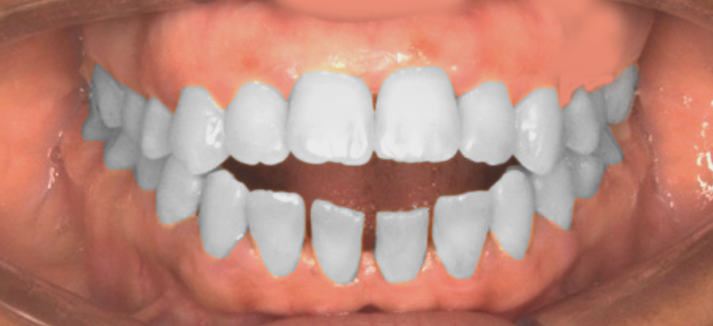 Treatment of open bite cases B