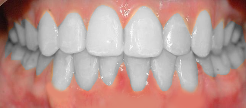 Relieving of dental crowding