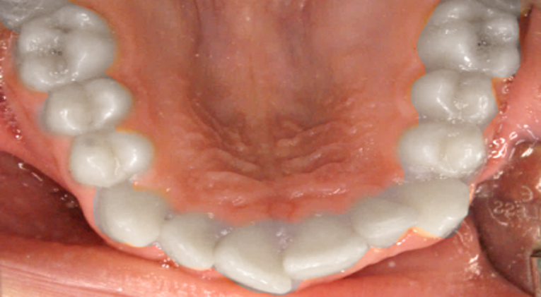 Relieving of dental crowding