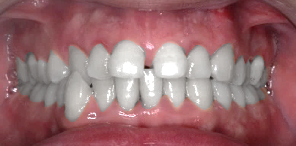 Closing Median  Diastema B
