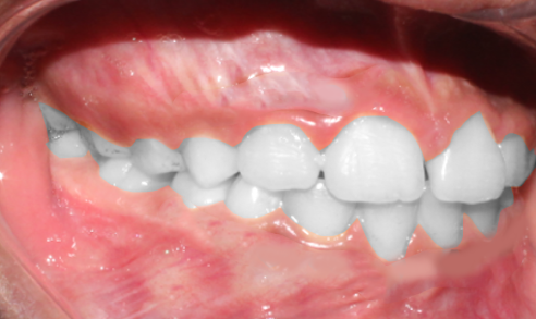 Treatment of arch retrusion A