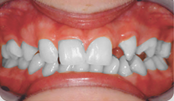 Treatment of missing teeth B2