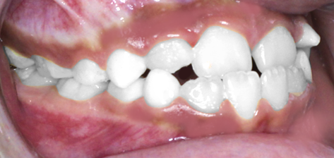 Treatment of arch retrusion B