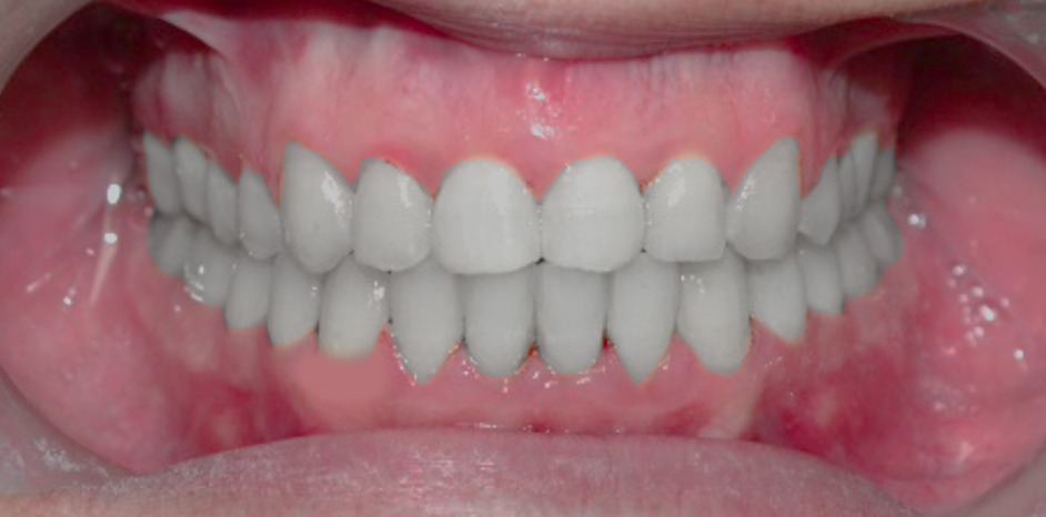 Closing Median  Diastema A