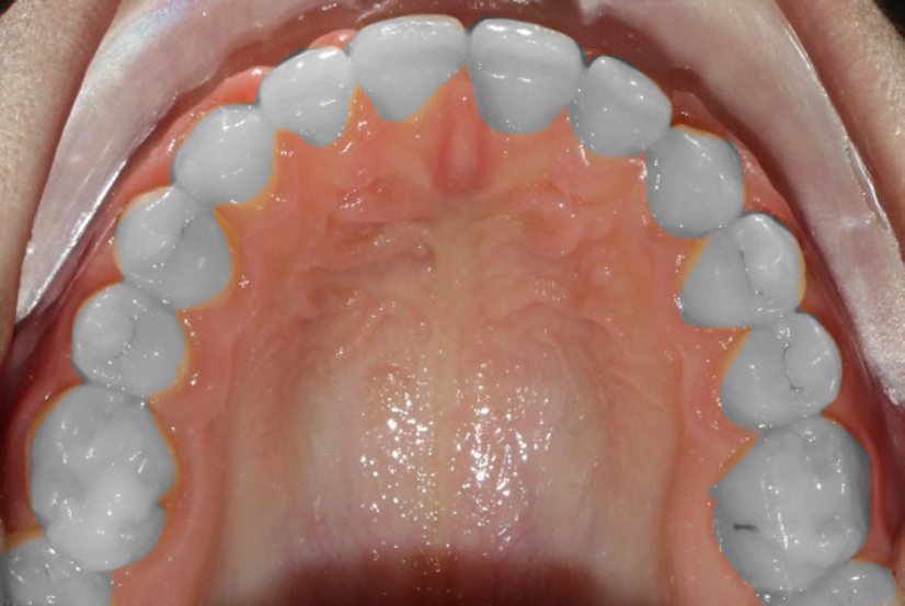 Closing  spaces between the teeth A