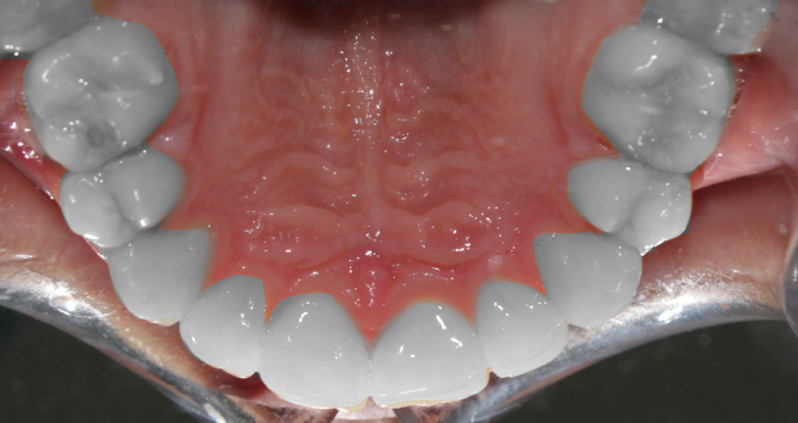 Relieving of dental crowding