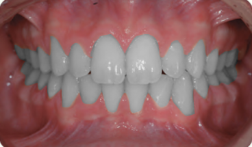 Treatment of Deep bite cases A