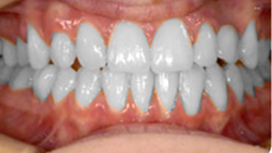 Treatment of missing teeth A2