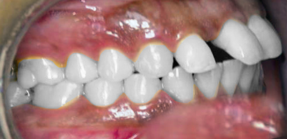 Treatment of arch protrusion B