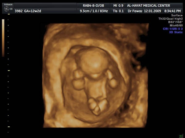 3d-4d ultrasound-doha-qatar
