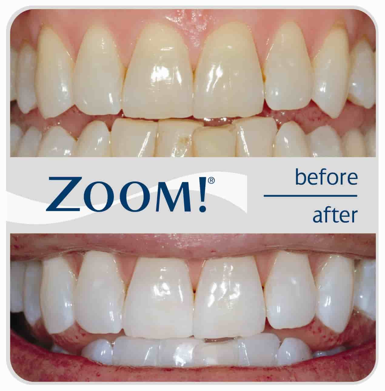 professional zoom teeth whitening professional zoom teeth whitening