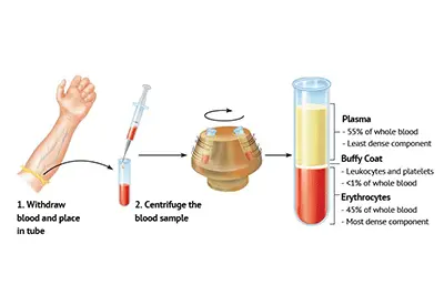 PRP Injection to treat skin and hair problems-1
