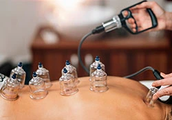 Cupping Clinic Services