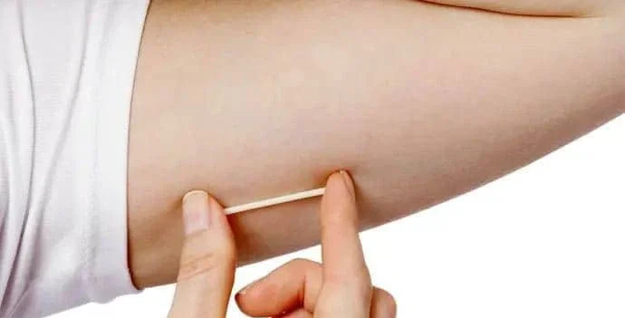 How the contraceptive implant is inserted